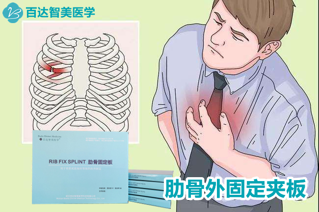 1753061203931824.jpg 肋骨固定板3_副本.jpg